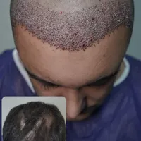 کاشت مو و مزوتراپی و PRP|خدمات آرایشگری و زیبایی|تهران, صادقیه|دیوار