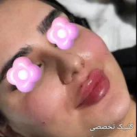 تزریق ژل و بوتاکس و کاشت نخ در کلینیک زیبایی|خدمات آرایشگری و زیبایی|خرم‌آباد, |دیوار