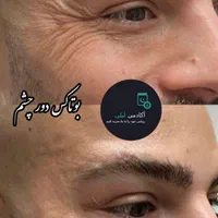 بوتاکس ژل لب زاویه فک.گونه .چانه. پرکردن صورت لاغر|خدمات آرایشگری و زیبایی|قم, زنبیل آباد|دیوار