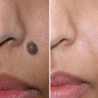 برداشتن زگیل ،خال ،میخچه،و بوتاکس میگرن|خدمات آرایشگری و زیبایی|سنندج, |دیوار