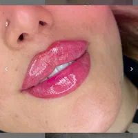 تزریق ژل لب بوتاکس آنزیم لیفت مادلینگ پکیج۱۰ سی سی|خدمات آرایشگری و زیبایی|تهران, باغ فیض|دیوار