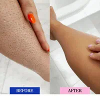 پوستی صاف و زیبا با لیزرسرد