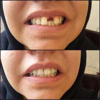 دندانسازی دندان مصنوعی|خدمات آرایشگری و زیبایی|شیراز, شهرک گلستان|دیوار
