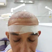 کاشت مو،کاشت ابرو و ریش تخصصی|خدمات آرایشگری و زیبایی|شیراز, قصرالدشت|دیوار