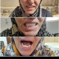 تعمیر و ساخت دندان‌های مصنوعی متحرک|خدمات آرایشگری و زیبایی|سمنان, |دیوار