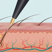 الکترولیز موهای سفید و مشکی