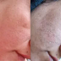 پاکسازی پوست|خدمات آرایشگری و زیبایی|بروجرد, |دیوار