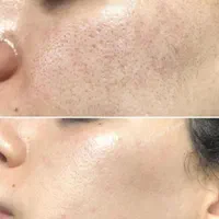 لیزر مو جشنواره. ژل بوتاکس حذف تتو و لک جوانسازی|خدمات آرایشگری و زیبایی|ساری, |دیوار
