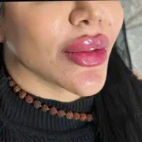 لیفت صورت با نخ. ژل.بوتاکس.مزوژل. درکلینیک|خدمات آرایشگری و زیبایی|کرمانشاه, |دیوار