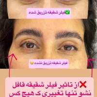 تزریق ژل بوتاکس لیفت صورت وشقیقه آنزیم مزو|خدمات آرایشگری و زیبایی|تهران, صادقیه|دیوار
