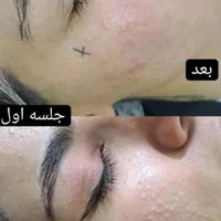 فیشیال و پاکسازی تخصصی درمانی ب مدت محدود|خدمات آرایشگری و زیبایی|کرمانشاه, |دیوار
