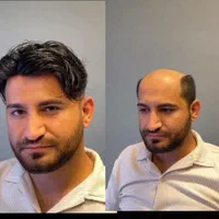 پروتز مو ، چسب پروتز ، ترمیم و تعویض چسب|خدمات آرایشگری و زیبایی|تبریز, |دیوار