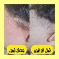 کلینیک تخصصی لیزر موهای زائد(الکساندرایت آمریکای)|خدمات آرایشگری و زیبایی|خرمشهر, |دیوار