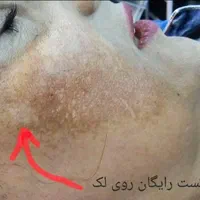 ریمو تتو و لک صورت با لیزر بدون زخم و نقاهت|خدمات آرایشگری و زیبایی|کرج, فاز ۲ مهرشهر|دیوار