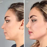 بوتاکس وژل.مزوسر   فقط۳۵۰|خدمات آرایشگری و زیبایی|کرج, بنیاد|دیوار