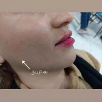 تزریق کامل بوتاکس و فیلر