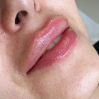 تزریق ژل لب و بوتاکس(پک 10cc)،جوانسازی و فیشال|خدمات آرایشگری و زیبایی|تهران, مهران (سیدخندان)|دیوار