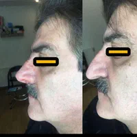 لیفت بینی بانخ|خدمات آرایشگری و زیبایی|تبریز, |دیوار