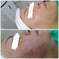 خدمات تخصصی پاکسازی فیشال صورت و بدن با دستگاه|خدمات آرایشگری و زیبایی|شاهین‌شهر, عطار|دیوار