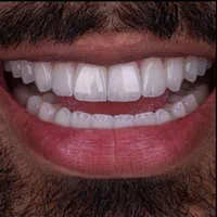 دندانپزشکی ایمپلنت اوردنچر روکش  تخصصی شمال غرب|خدمات آرایشگری و زیبایی|تبریز, |دیوار