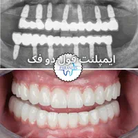 دندانپزشکی تخصصی ایمپلنت پیوند استخوان /اقساط|خدمات آرایشگری و زیبایی|تهران, پونک|دیوار