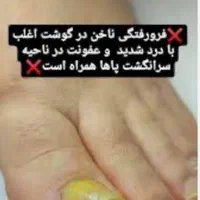 ارتونیل ناخن(ناخن فرورفته در گوشت) درمان عفونت|خدمات آرایشگری و زیبایی|اصفهان, طامه|دیوار