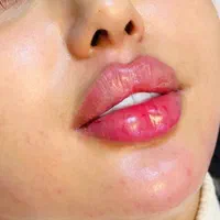 جشنواره ژل وبوتاکس|خدمات آرایشگری و زیبایی|همدان, |دیوار