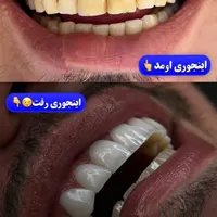 آفرعیدانه‌‌‌طرح‌لبخندکامپوزیت‌ولمینت‌دندان|خدمات آرایشگری و زیبایی|تهران, شهید رجایی|دیوار