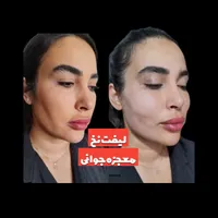 لیفت نخ معجزه جوانی و لیفتینگ صورت بدون جراحی|خدمات آرایشگری و زیبایی|شاهین‌شهر, فردوسی|دیوار