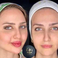 تزریق ژل و بوتاکس و مادلینگ خلیجی و هایفو درکلینیک|خدمات آرایشگری و زیبایی|کرمانشاه, |دیوار