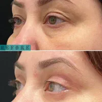 جشنوار بلفارو پلاستی و جراحی پلک|خدمات آرایشگری و زیبایی|کرج, مهرویلا جنوبی|دیوار