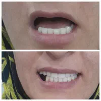 دندان مصنوعی|آرایشی، بهداشتی، درمانی|کاشان, راه آهن کاشان|دیوار