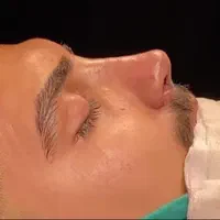 جراحی بینی بلفارو پلاستی ساکشن ابدو لیفت شقیقه|خدمات آرایشگری و زیبایی|مشهد, سجاد شهر|دیوار