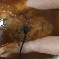 سمزدایی بدن|خدمات آرایشگری و زیبایی|قرچک, مهدیه|دیوار