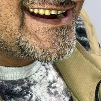 ساخت دندان مصنوعی تحویل یک روزه|خدمات آرایشگری و زیبایی|قم, بکایی|دیوار