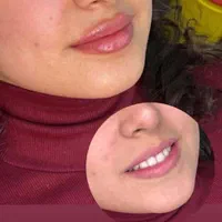جشنواره ژل و بوتاکس کلینیک وی ای پی
