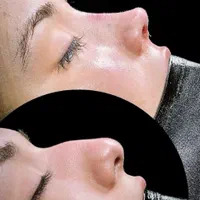 عمل بینی.لیفت|خدمات آرایشگری و زیبایی|کرج, کرج نو|دیوار