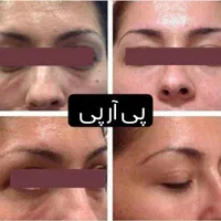 جشنواره تخفیف ویژه لیزر،ژل،بوتاکس،کلیه خدمات پزشکی|خدمات آرایشگری و زیبایی|ساری, |دیوار