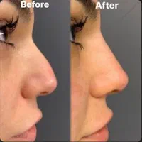 تزریق ژل مدل زاویه،گونه،چونه،لب|خدمات آرایشگری و زیبایی|تهران, امام زاده حسن|دیوار
