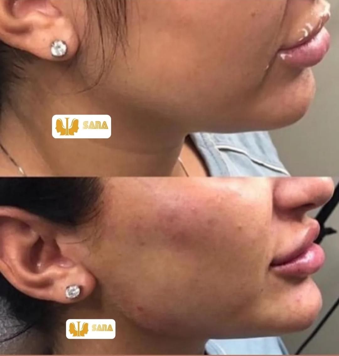 تزریق ژل و بوتاکس|خدمات آرایشگری و زیبایی|اهواز, نادری|دیوار