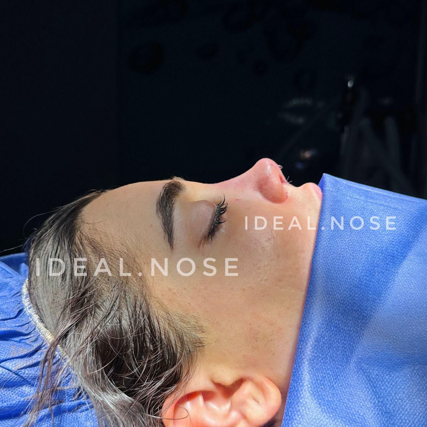 جشنواره عمل زیبایی بینی با تخفیف ویژه|خدمات آرایشگری و زیبایی|الوند, |دیوار