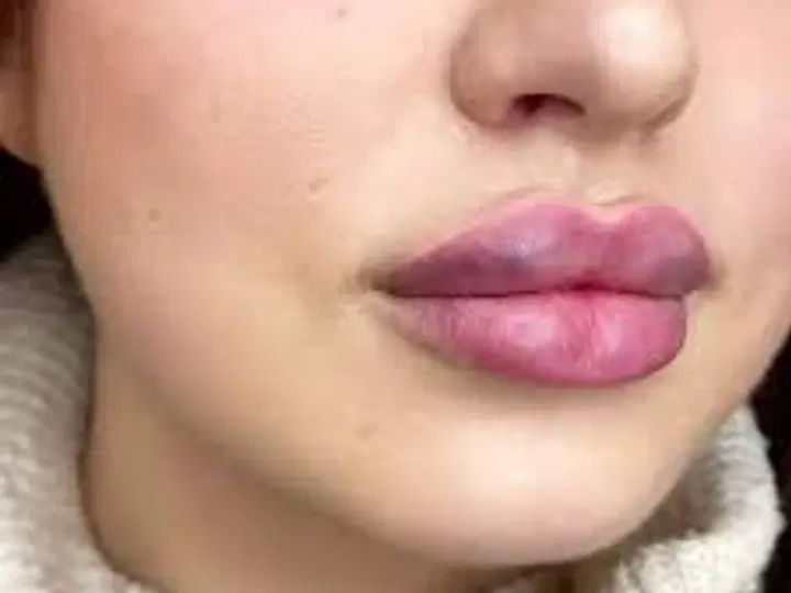 اف ویژه اموزش و خدمات فیلر و ژل بوتاکس کراتین خال|خدمات آرایشگری و زیبایی|دزفول, |دیوار