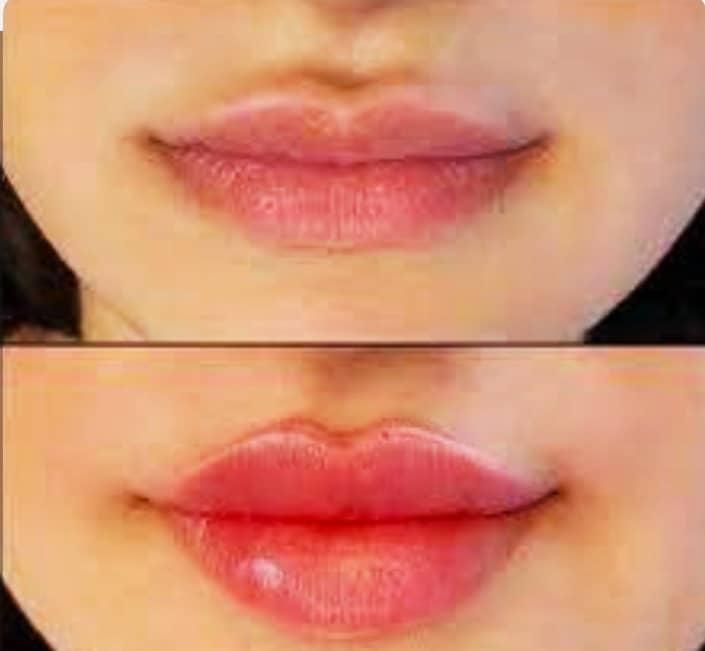 تزریق ژل و بوتاکس و فیلر بادی باتخفیف توسط پزشک|خدمات آرایشگری و زیبایی|شیراز, کلاهدوز|دیوار