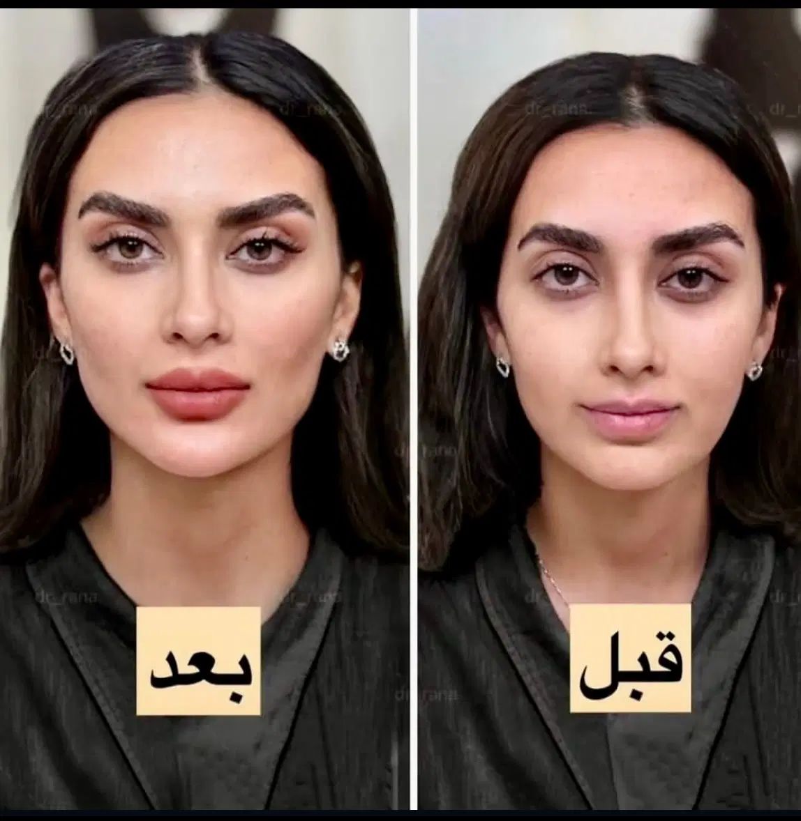 فیلر زل بوتاکس مزو بایو فیس لیفت پر کننده50/|خدمات آرایشگری و زیبایی|مشهد, هفت تیر (حافظ)|دیوار