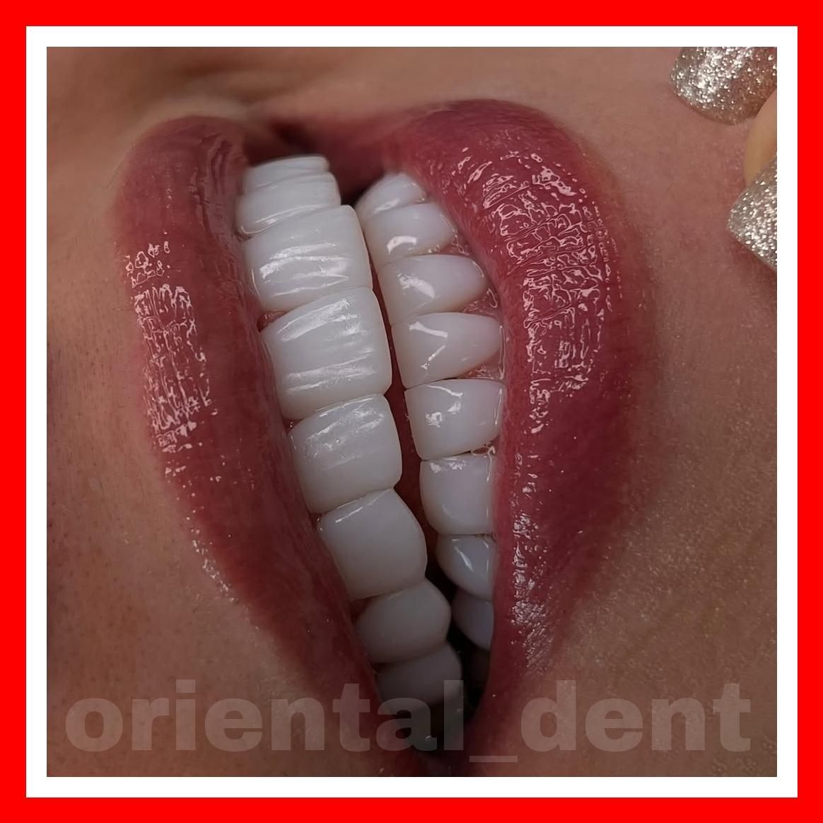 دندانپزشکی/کامپوزیت دندان/ترمیم/روکش/عصبکشی|خدمات آرایشگری و زیبایی|تهران, تهرانپارس شرقی|دیوار