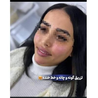 جشنواره ژل و بوتاکس|خدمات آرایشگری و زیبایی|تهران, هفت حوض|دیوار