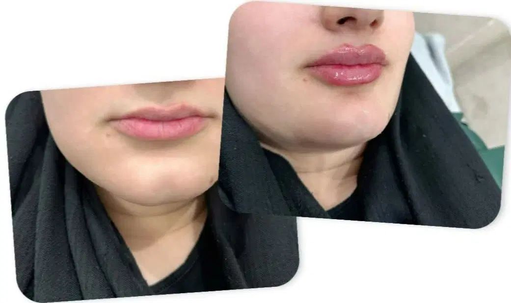 ژل بوتاکس پی از پی مزو فیشال میکرو فیلر بیکنی|خدمات آرایشگری و زیبایی|مشهد, فرهنگیان (شهرک غرب)|دیوار