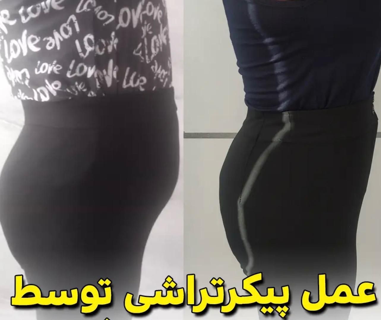 ساکشن شکم .غبغب .تزریق چربی .فیلر.پهلوتوسط پزشک|خدمات آرایشگری و زیبایی|کرمانشاه, |دیوار