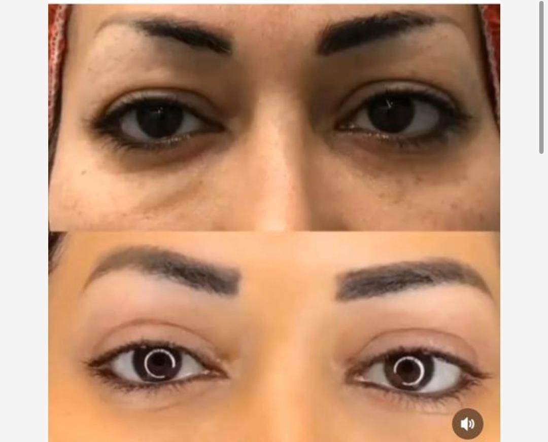جراحی زیبایی پلک با قیمت مناسب|خدمات آرایشگری و زیبایی|تهران, نصرت|دیوار