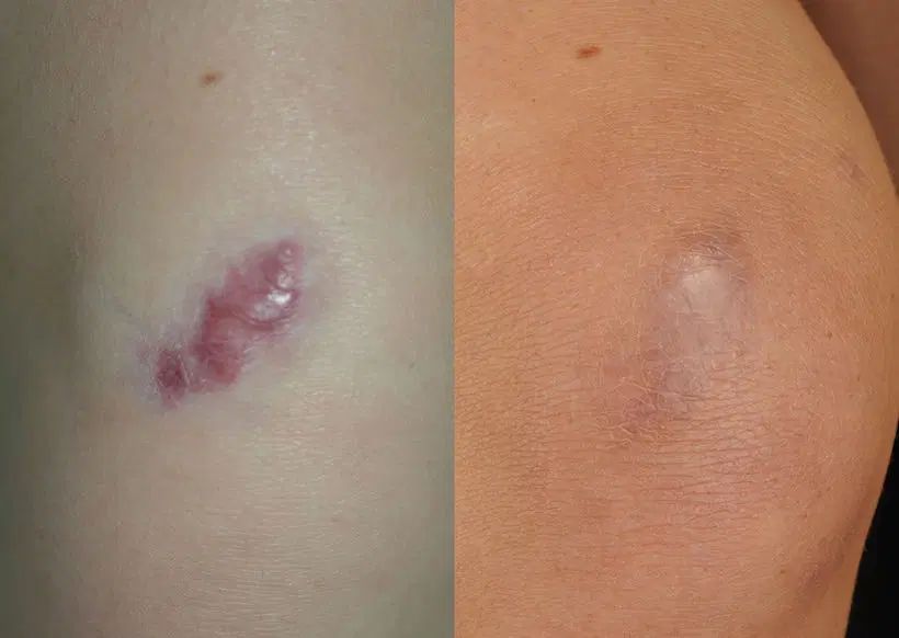 افرتابستانه از بین بردن تخصص جای جوش و اسکار پوستی|خدمات آرایشگری و زیبایی|شیراز, باهنر|دیوار